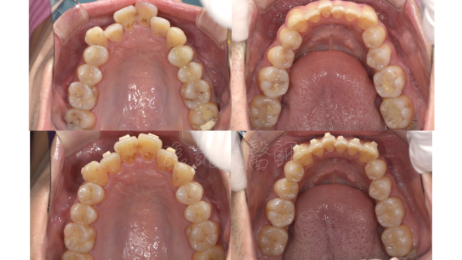 矯正前要注意牙齒什麼問題呢？ PART I 疾病治療篇：蛀牙、神經發炎、牙周病